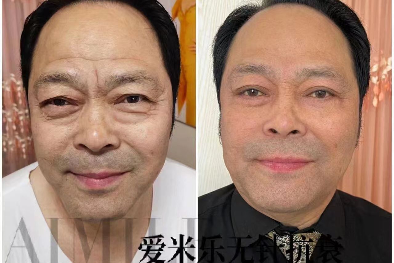 眼角纹
