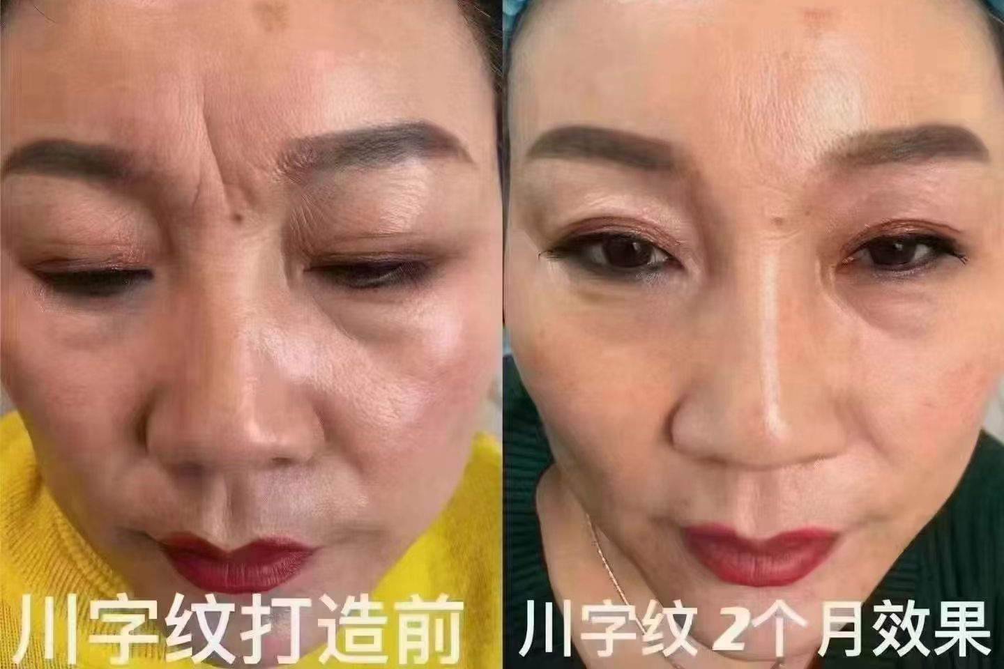 川字纹