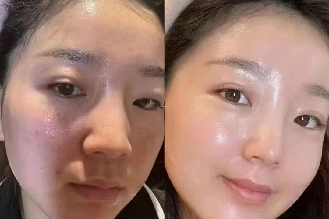 婴儿肌水光
